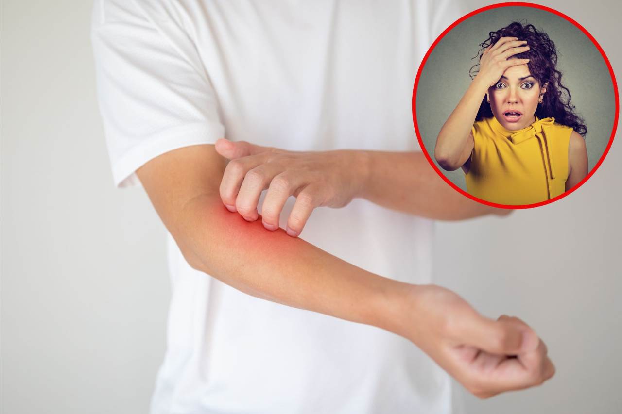 Dermatite Da Contatto Come Riconoscerla E Le Cure NewsSalute It